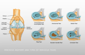 Types of Meniscus Tears Illustration